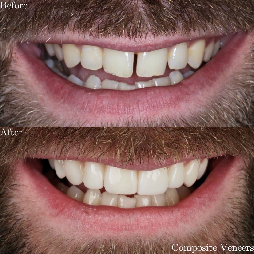 Smile Gallery Composite Veneers - Before & After Treatment