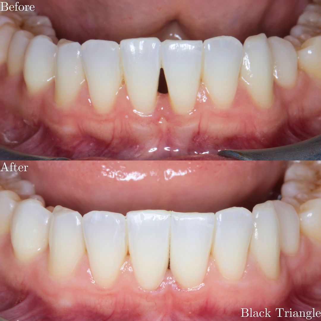 Smile Gallery Composite Veneers - Before & After Treatment