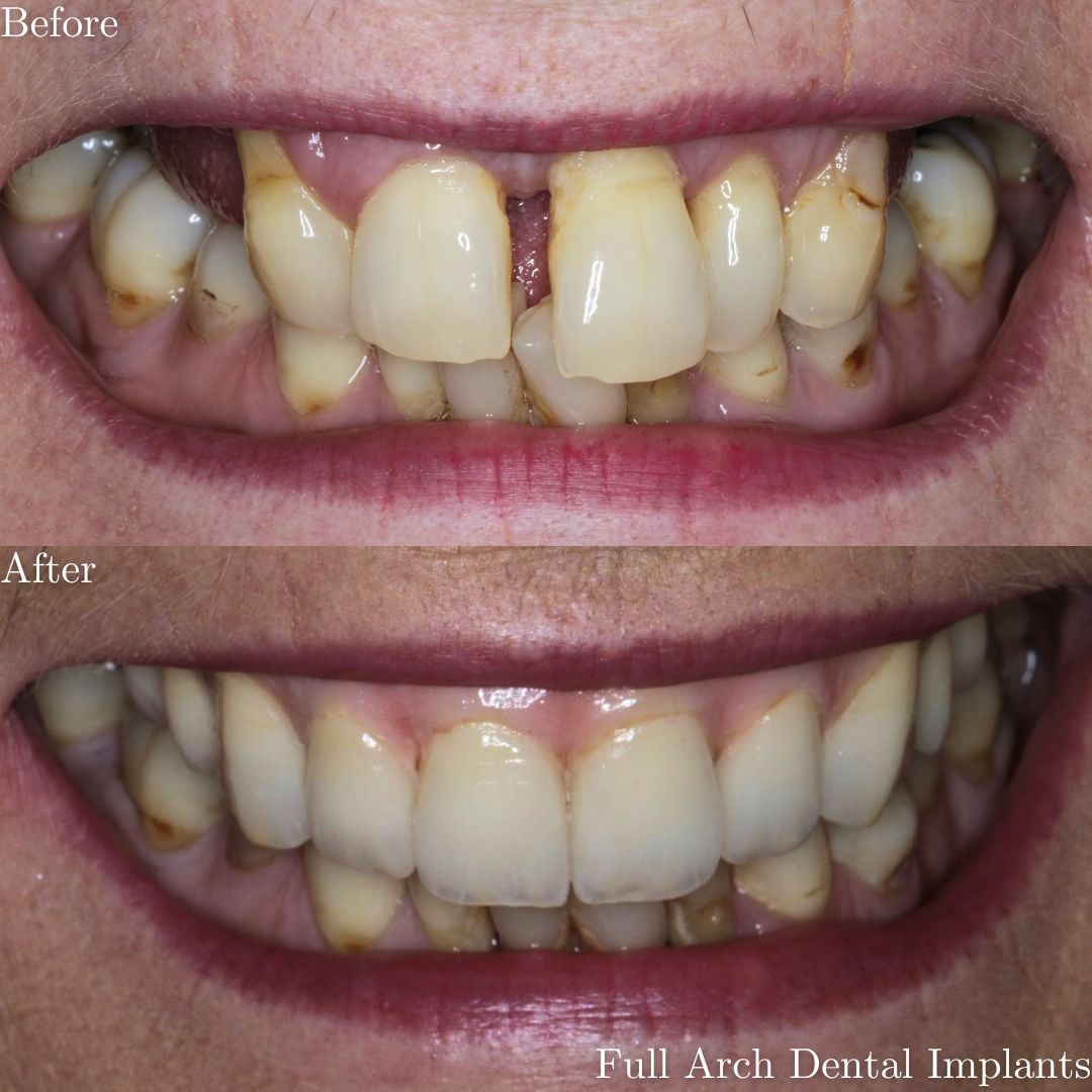 Full Mouth Rehabilitation Full Mouth Rehabilitation