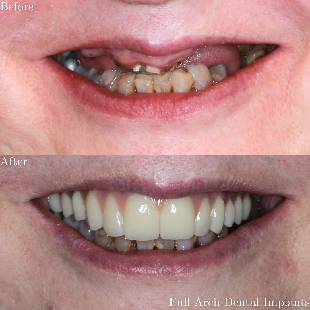 Full Mouth Rehabilitation Full Mouth Rehabilitation