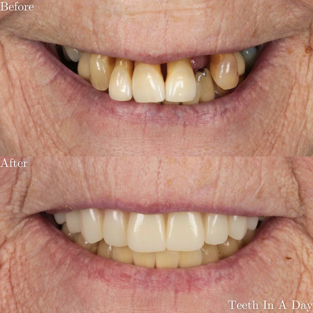 Smile Gallery Teeth In A Day - Before & After Treatment