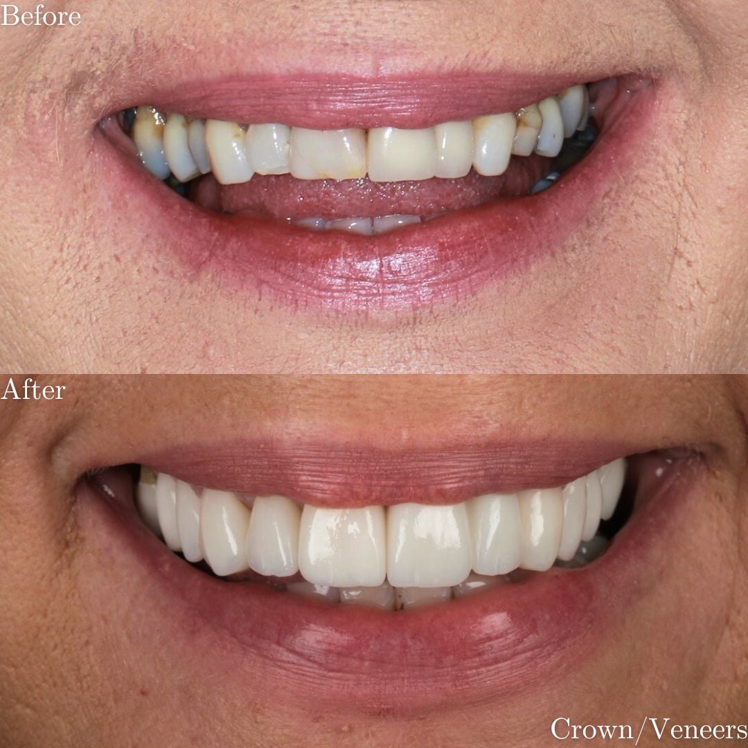 Smile Gallery Crowns & Veneers - Before & After Treatment