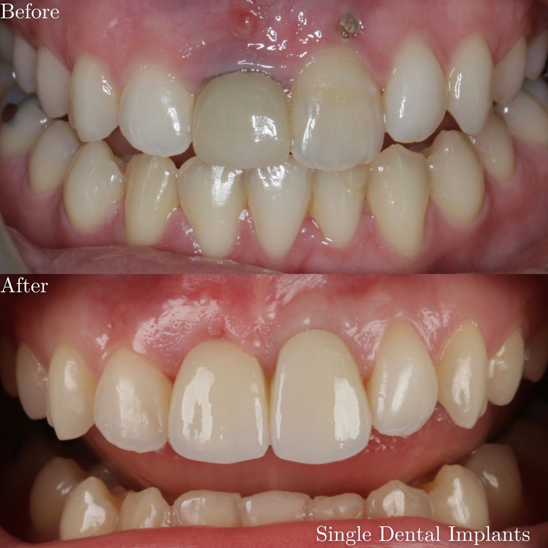 Dental Implants Dental Implants