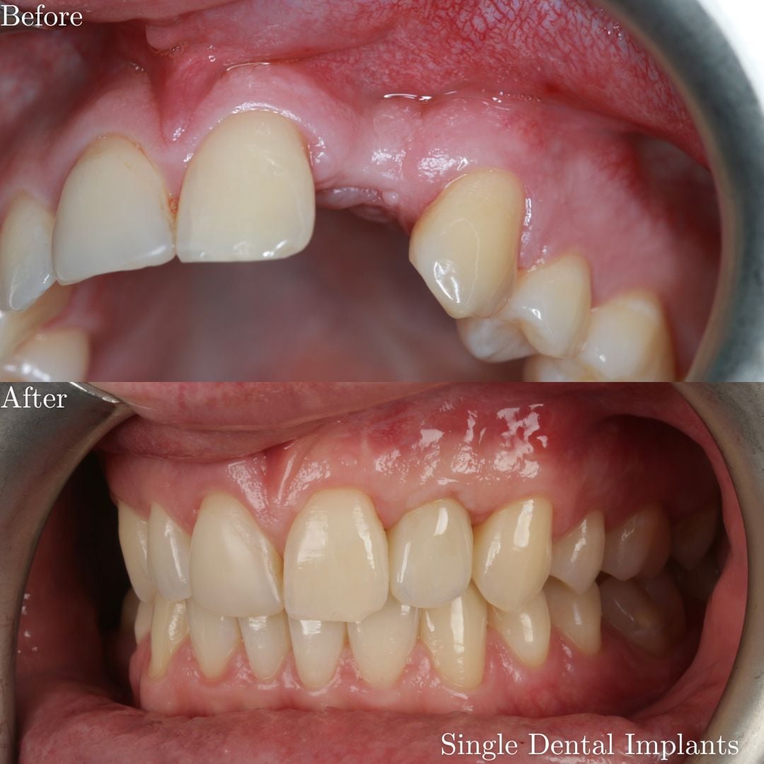 Dental Implants Dental Implants
