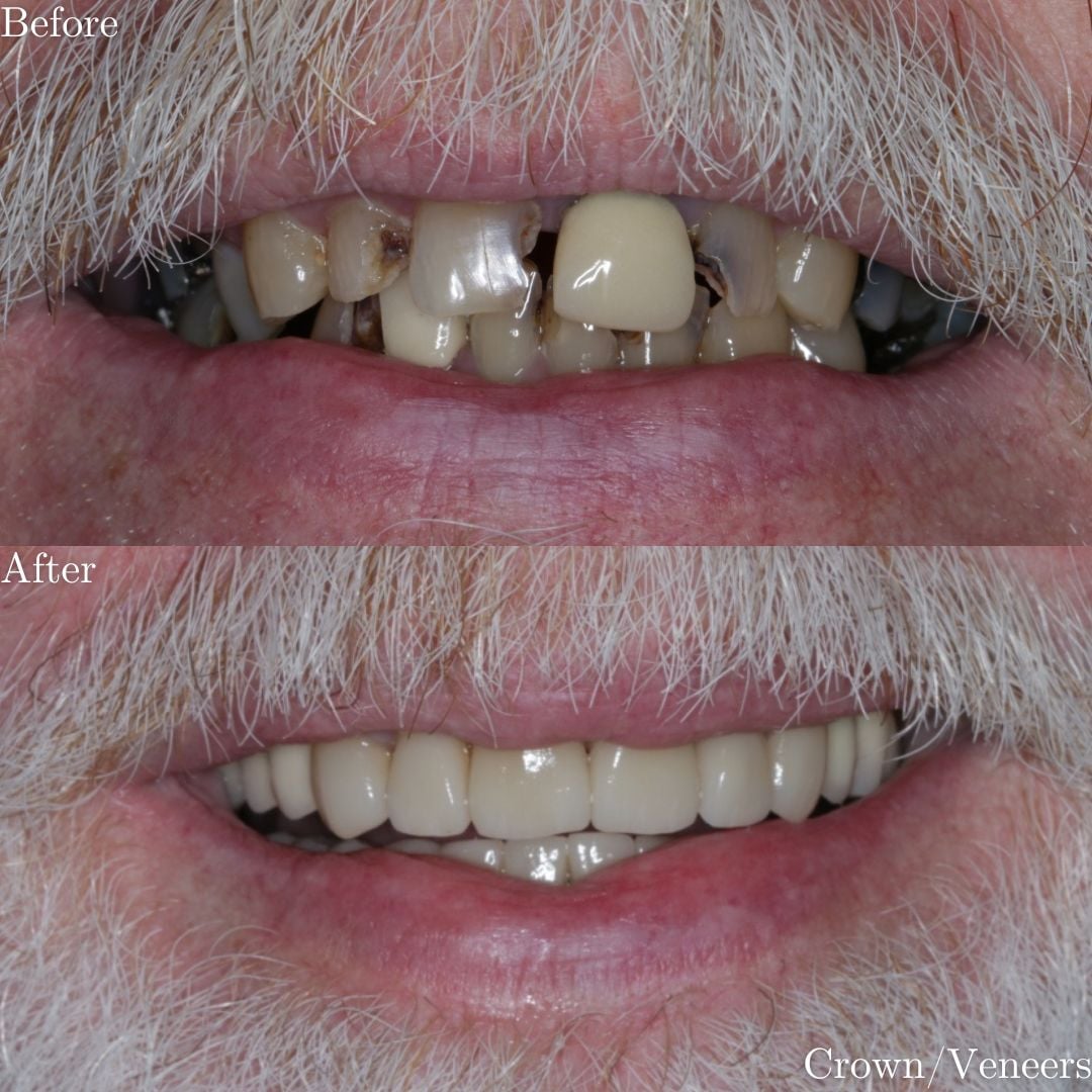 Full Mouth Rehabilitation Full Mouth Rehabilitation