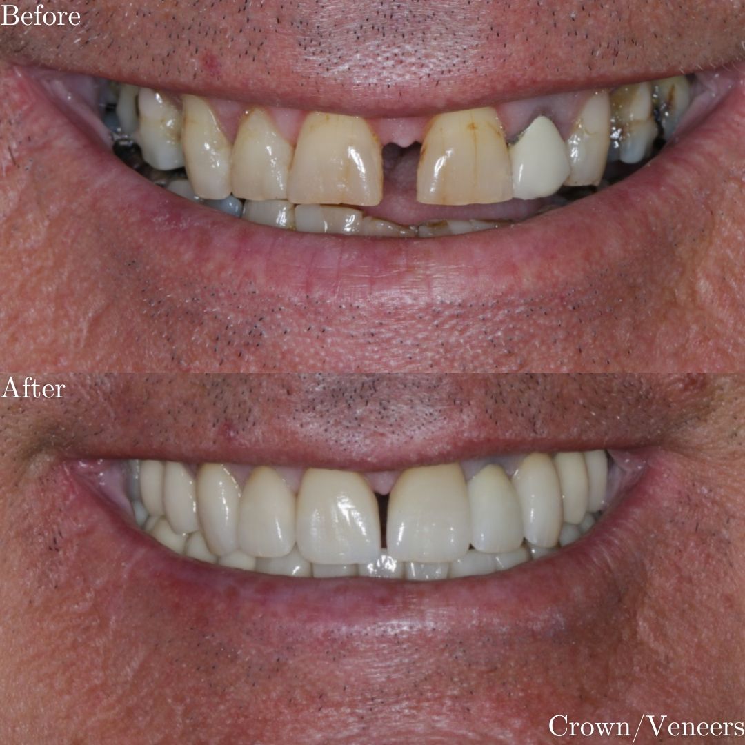Full Mouth Rehabilitation Full Mouth Rehabilitation