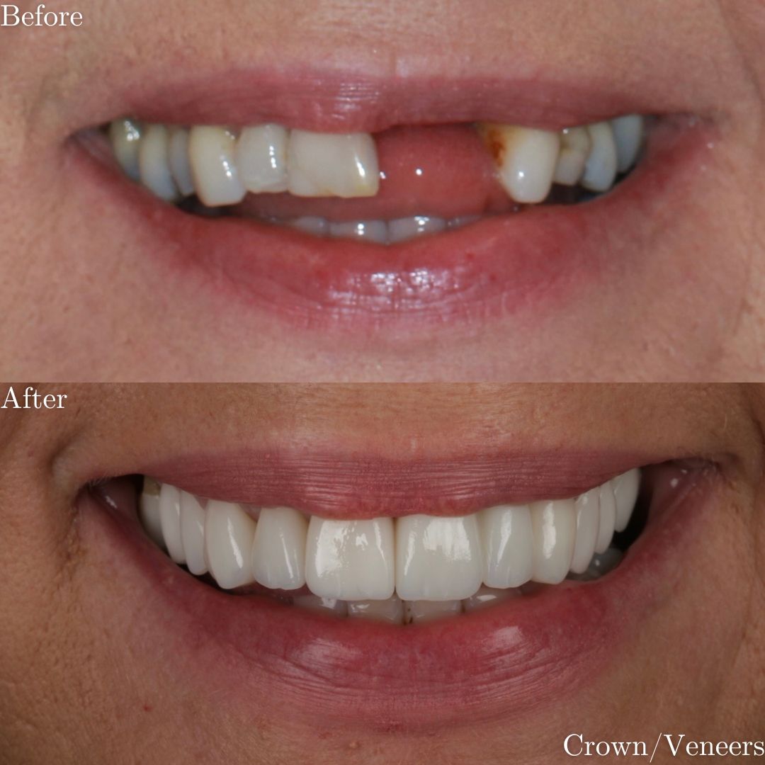 Smile Gallery Crowns & Veneers - Before & After Treatment