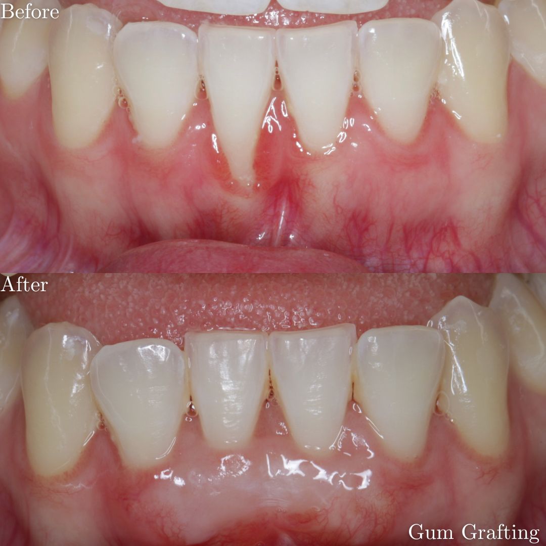 Smile Gallery Gum Grafting - Before & After Treatment
