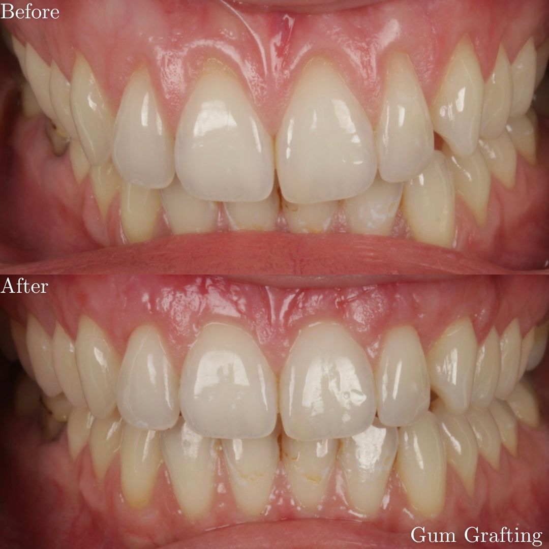 Smile Gallery Gum Grafting - Before & After Treatment