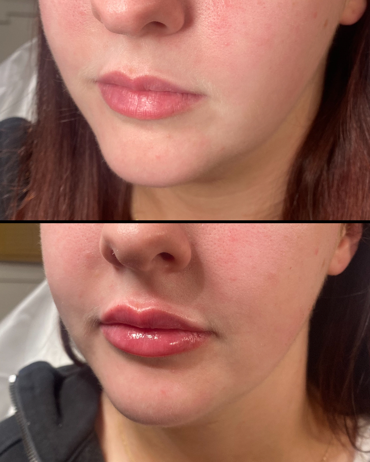 Before and after facial aesthetic treatment